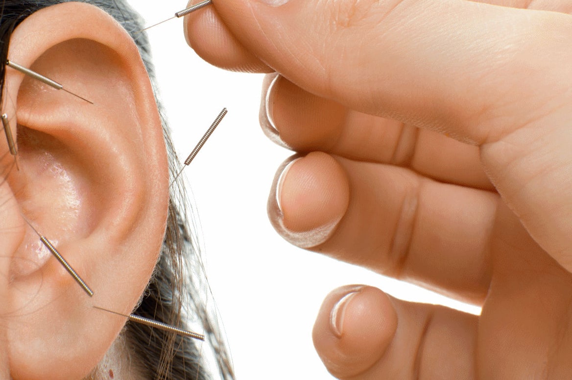 Auricular Acupuncture