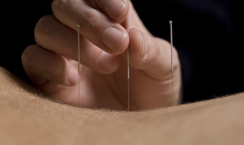 Acupuncture