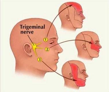 What is trigeminal neuralgia?