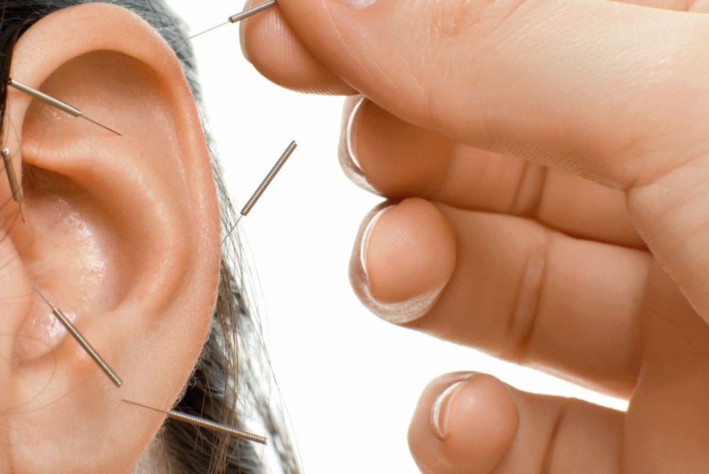 Auricular Acupuncture 3 Acupuncture treatment on the ear at Almond Wellness Centre Melbourne