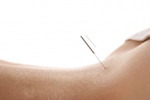 acupuncture for back pain