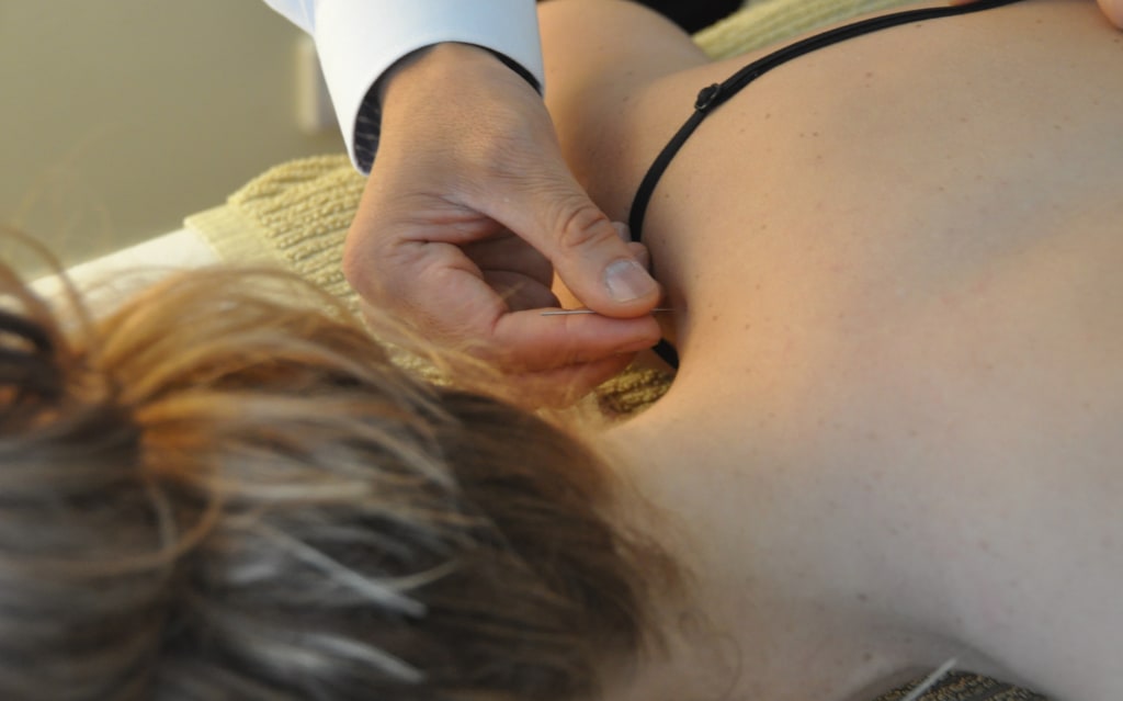 Acupuncture sensation 1 acupuncture on shoulder point often has strong "twitching" sensation