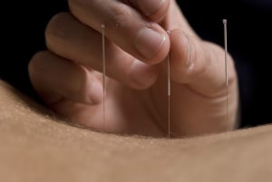 traditional needle acupuncture