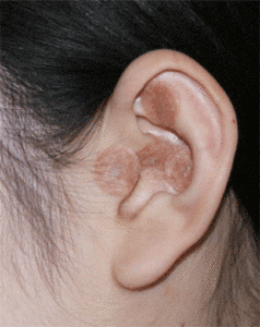 auricular acupuncture