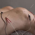 electro-acupuncture on knee