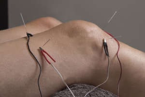 Arthritis Acupuncture Chinese Medicine 2 electro acupuncture treatment for knee arthritis