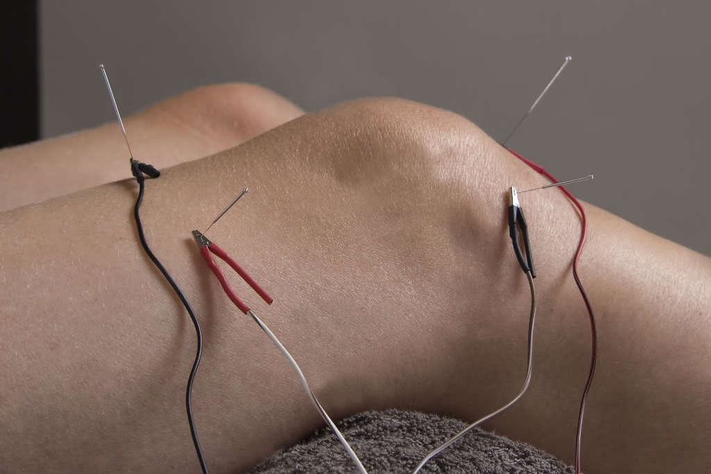 Electro-acupuncture