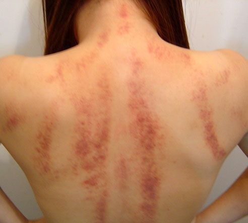 Gua Sha Therapy 2 Bruise Marks on back from Gua Sha (scraping ) therapy