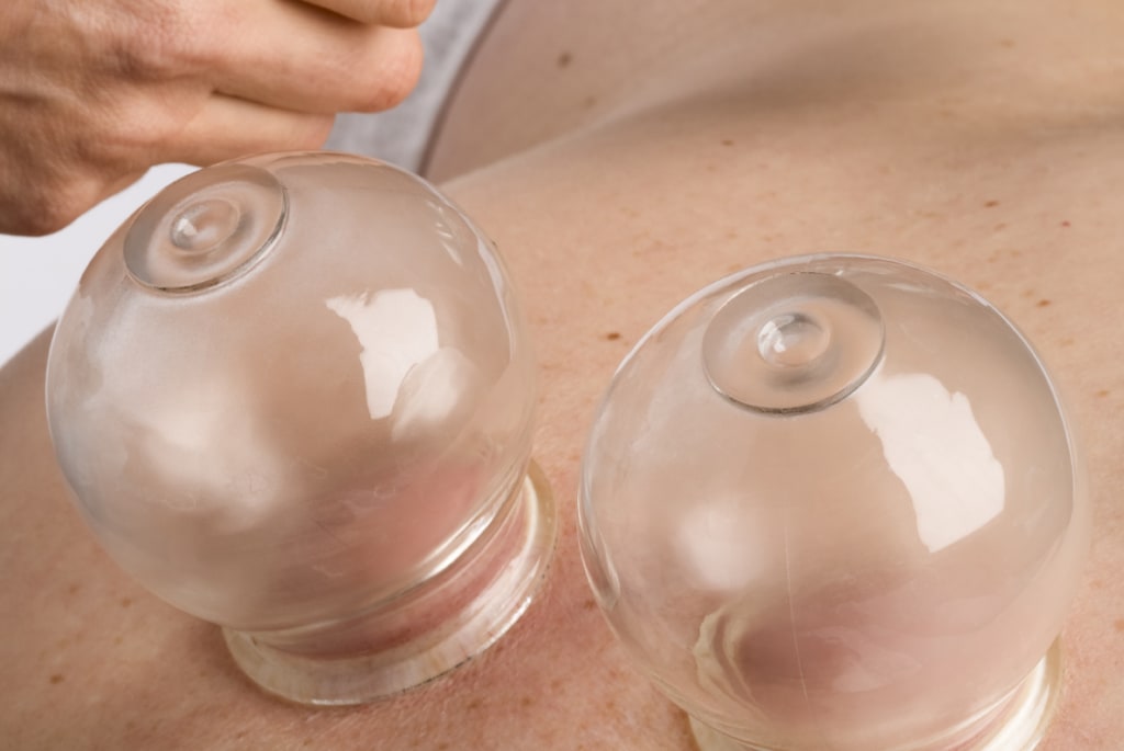 墨尔本中医针灸-杏林中医中心 3 Cupping therapy at Almond Wellness Centre Melbourne