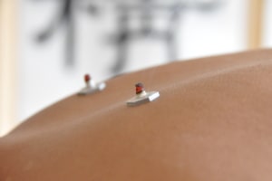 moxibustion treatment on back