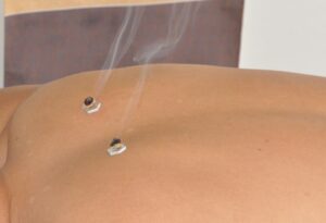 moxibustion