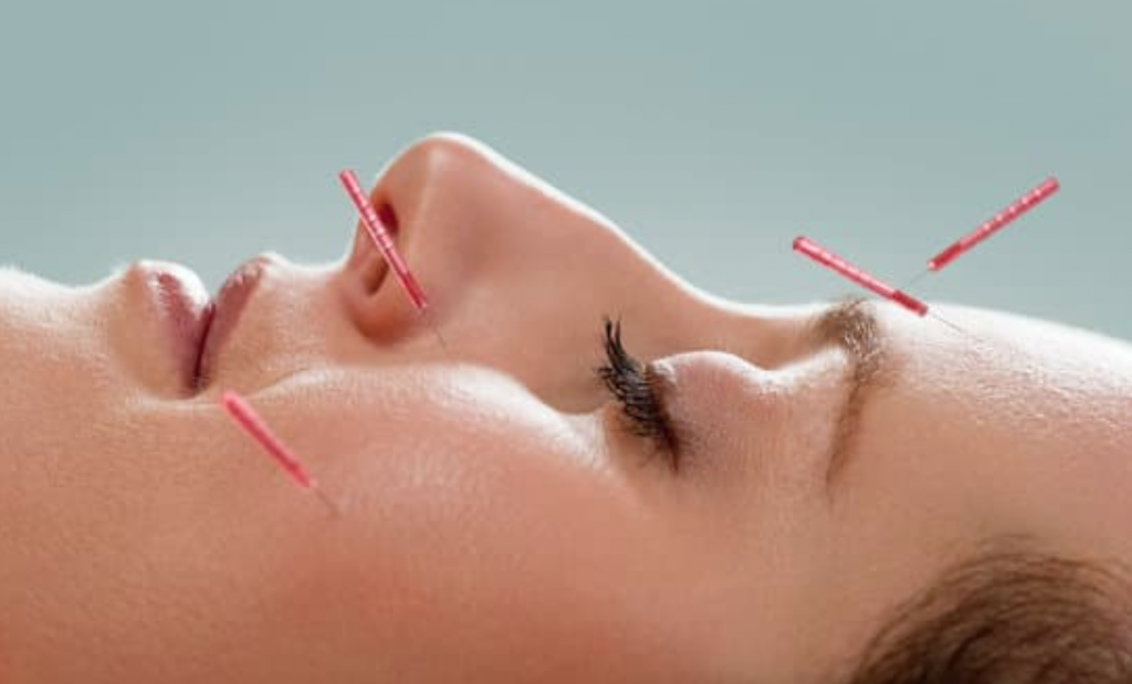 Cosmetic Acupuncture Melbourne 3 Cosmetic facial acupuncture treatment at Almond Wellness Centre Ringwood Melbourne
