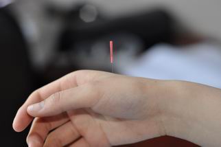 Acupuncture on hand