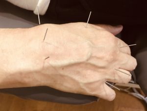 acupuncture on hands