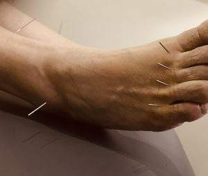 Acupuncture for arthritis on feet