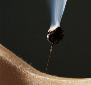 moxibustion on acupuncture needles for back pain