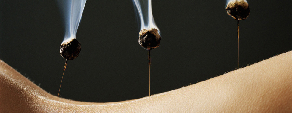 Ankylosing Spondylitis Acupuncture Melbourne 1 moxibustion on top of acupuncture needles at Almond Wellness Centre in Melbourne