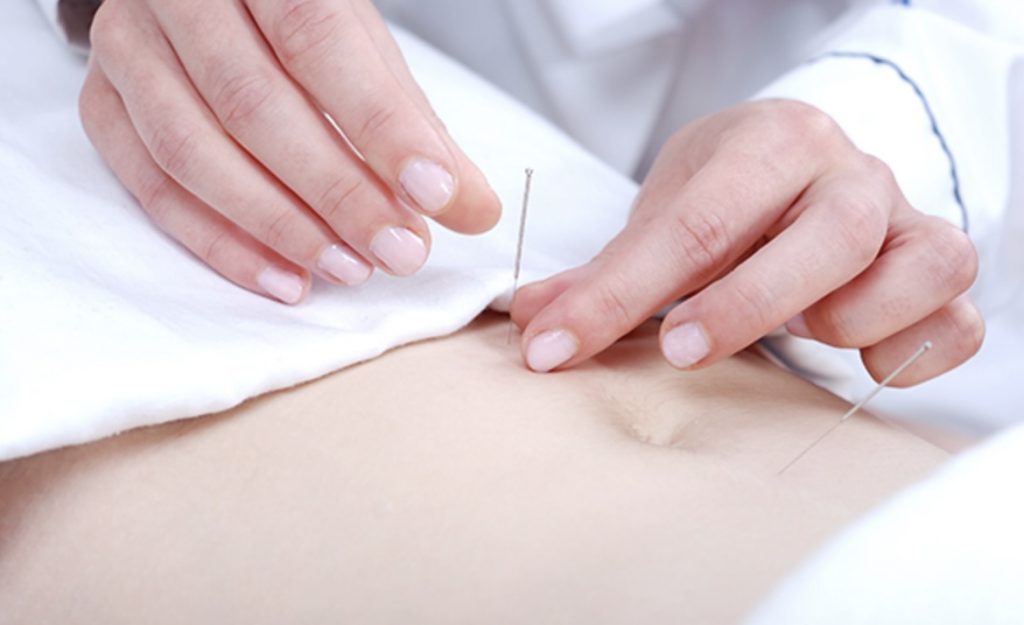 中医针灸师曾医生 | 墨尔本助孕与生育专家 1 IVF acupuncture Melbourne