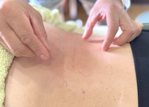 acupuncture for Fibromyalgia