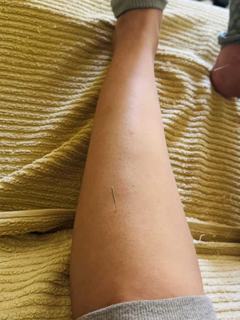 acupuncture on zu san li ST36
