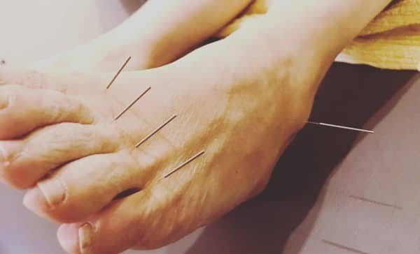 Cancer Support 4 acupuncture for chemo induced neuropathy on feet