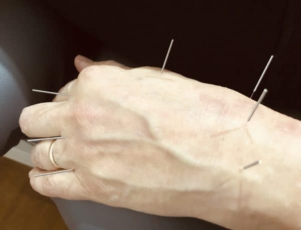 Cancer Support 1 acupuncture for chemo induced neuropathy on hands at Almond Wellness Centre Melbourne