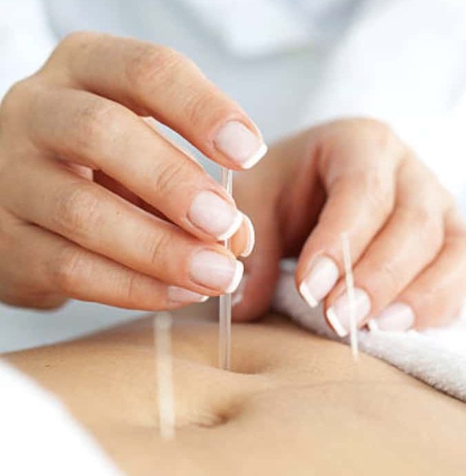 Is Acupuncture Safe During Your Period? Should You Avoid It? 1 A acupuncturist at Almond Wellness Centre in Melbourne provides gentle acupuncture during menstruation for menstrual and fertility health