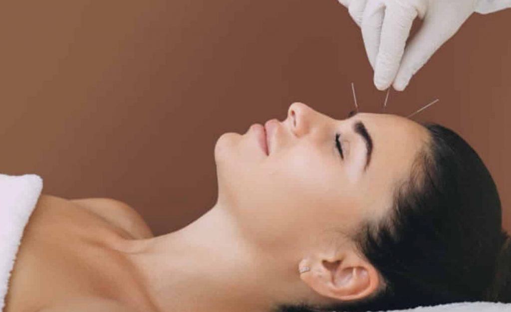 IVF Acupuncture Melbourne 3 Relaxed woman receiving gentle facial acupuncture for stress relief during IVF at Almond Wellness Centre Melbourne