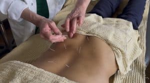 Services 4 Acupuncture for lower back pain at Almond Wellness Centre Melbourne clinic