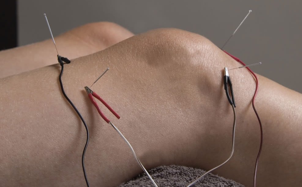 Electroacupuncture 1 electro-acupuncture at Almond Wellness Centre Melbourne
