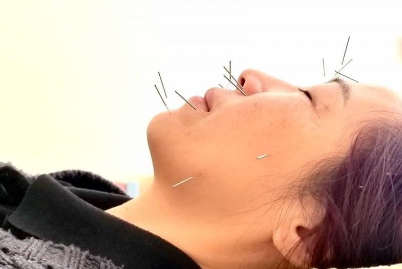 Trigeminal Neuralgia 3 Trigeminal Neuralgia Acupuncture Treatment at Almond Wellness Centre Melbourne
