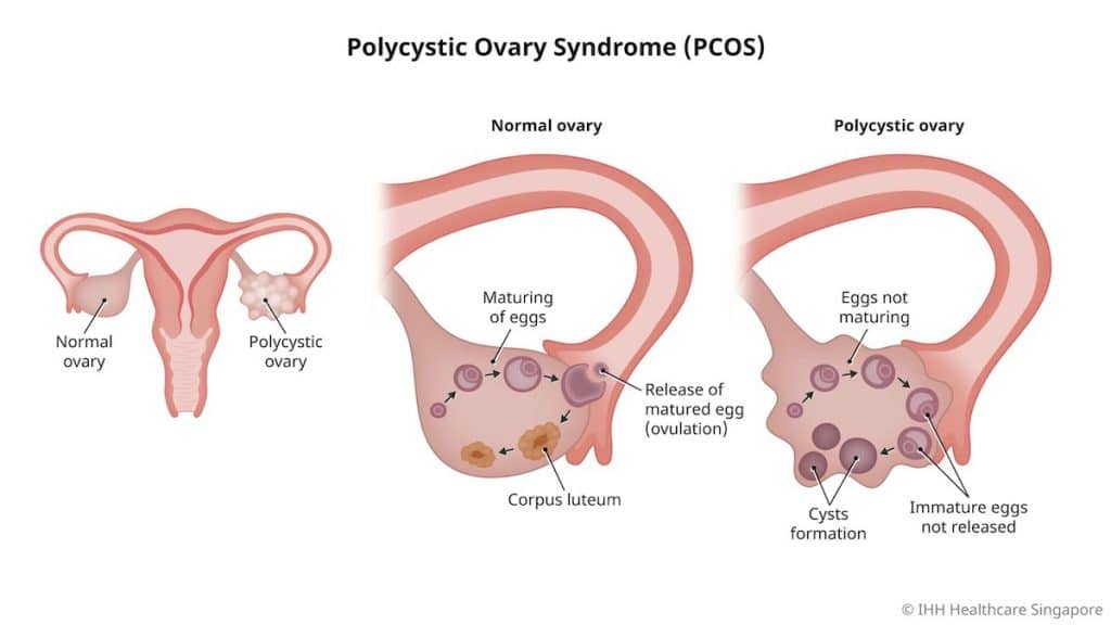 PCOS 1 polycystic ovarian syndrome