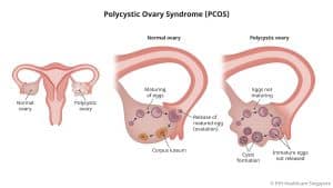 Fertility Acupuncture Melbourne 4 polycystic ovaries - how cysts are formed