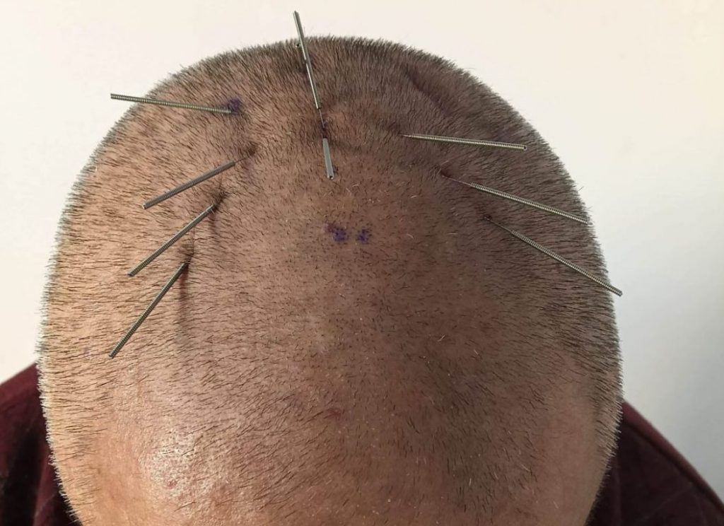 Acupuncture for Stroke 2 scalp acupuncture for stroke recovery