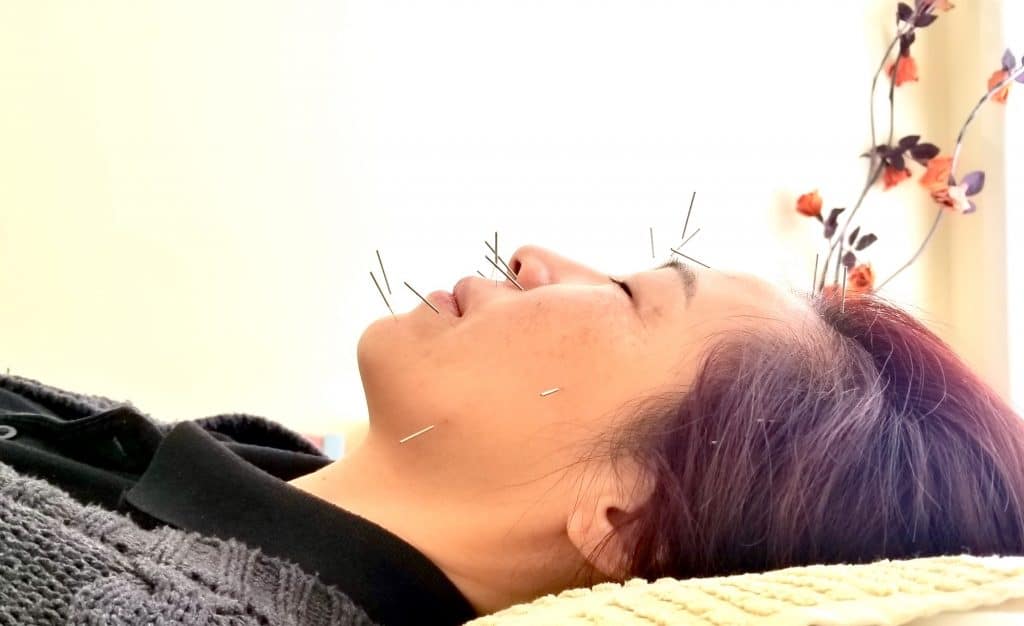 First Visit 1 acupuncture treatment on the face in Ringwood clinic