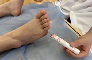 Pregnancy Acupuncture in Melbourne 5 Moxibustion on BL67 Zhiyin point for breech baby — Almond Wellness Centre Melbourne