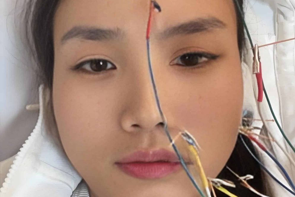 Acupuncture For Bell’s Palsy Melbourne 4 electroacupuncture for bell's palsy facial paralysis at Acupuncture Melbourne