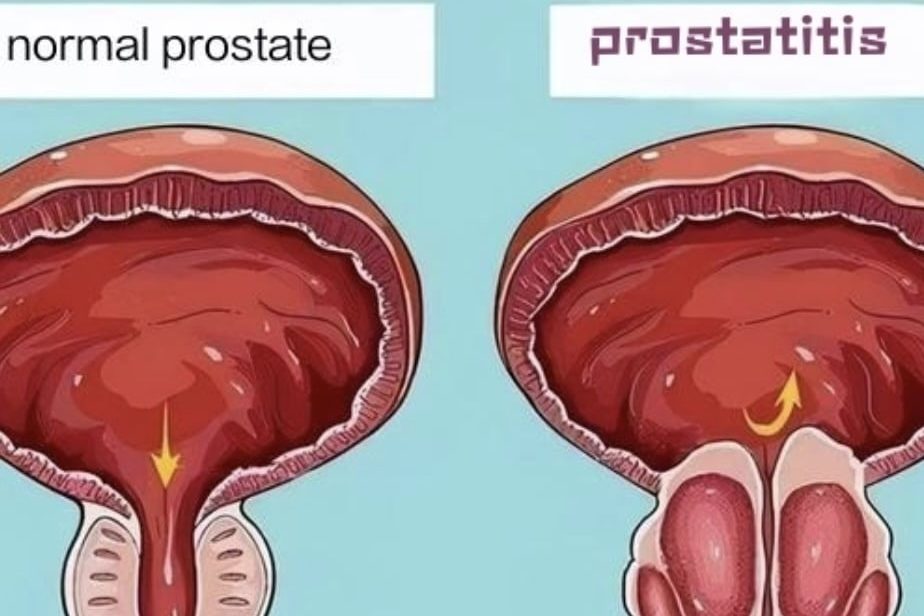 Prostatitis 1 normal and inflamed prostate