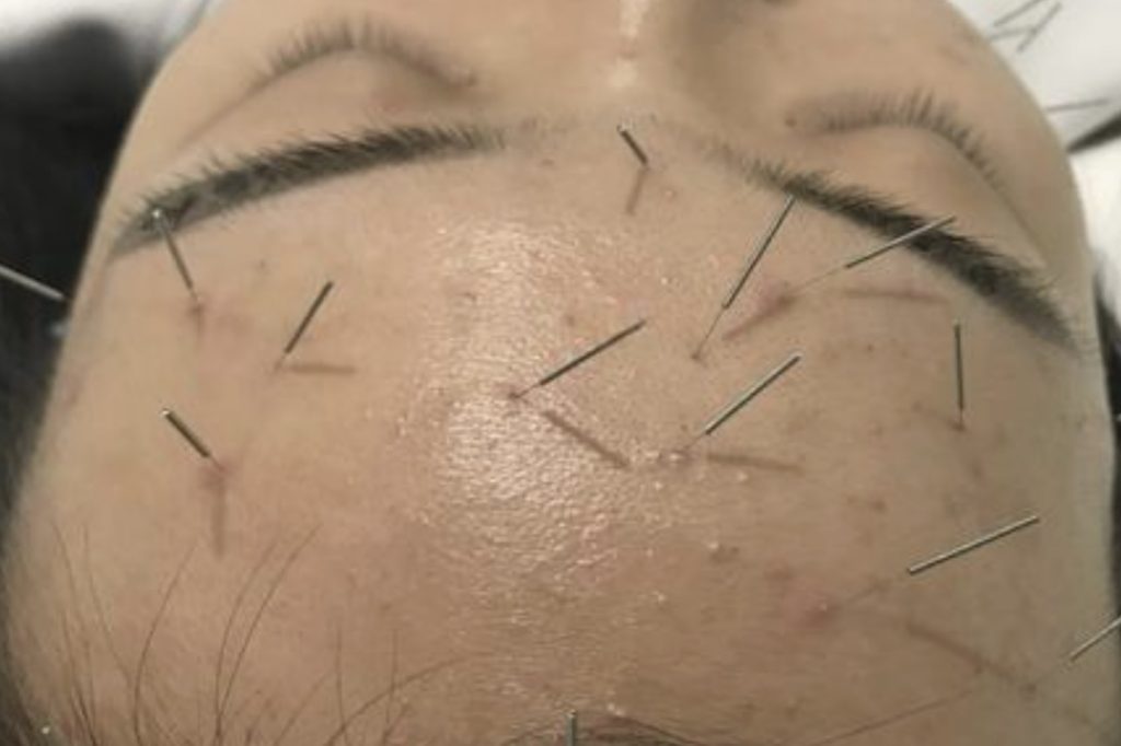Cosmetic Acupuncture Melbourne 4 acupuncture treatment for acne in Melbourne