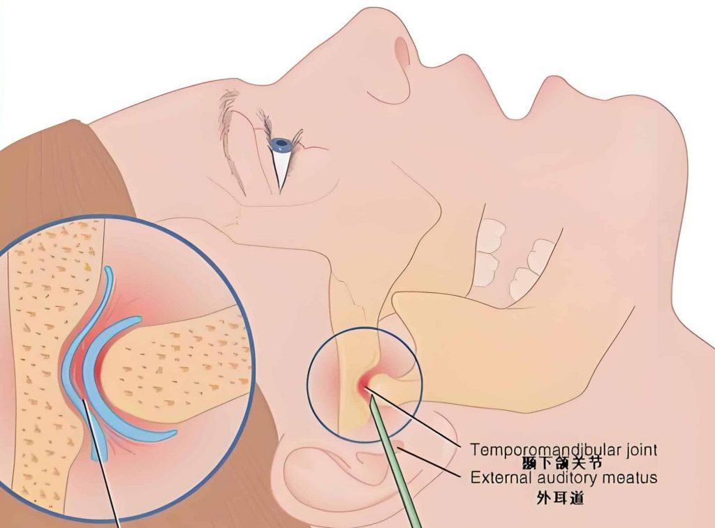 TMJ Jaw Pain 1 inflamed TMJ causes jaw pain
