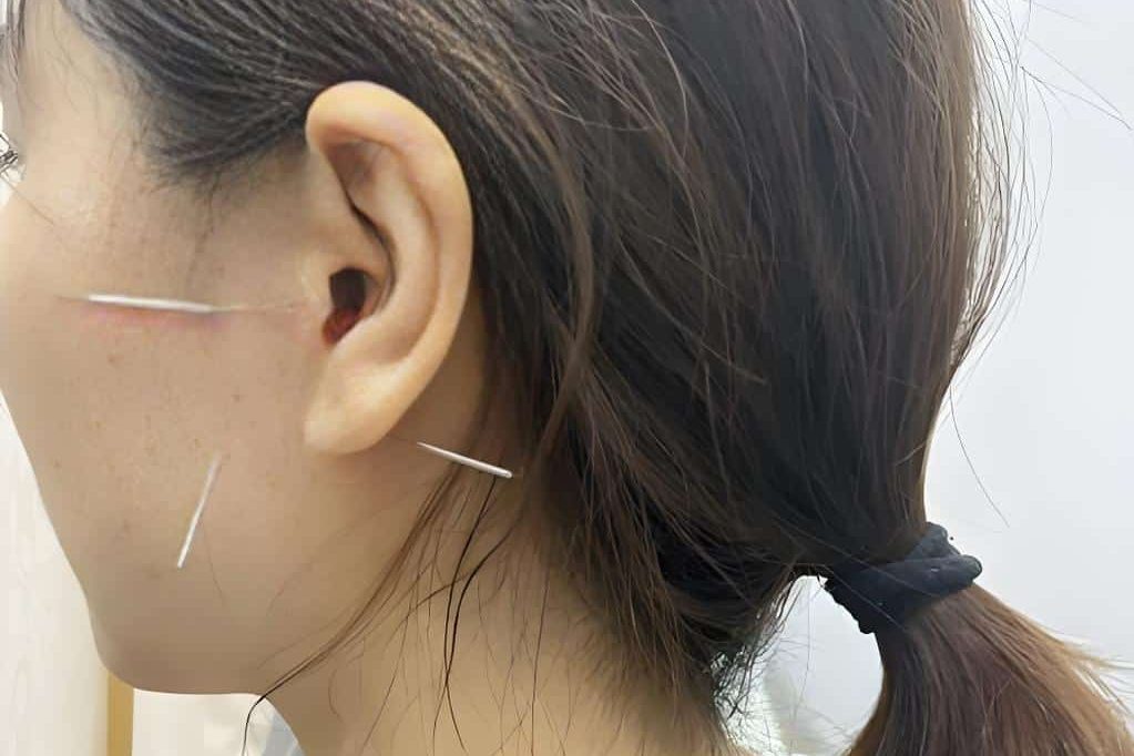 TMJ Jaw Pain 2 Acupuncture for TMJ Jaw Pain in Melbourne