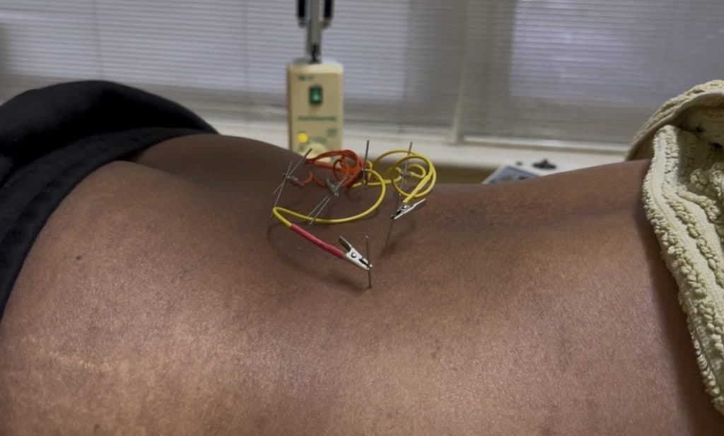 Ankylosing Spondylitis Acupuncture Melbourne 2 electroacupuncture for back pain and stiffness at Almond Wellness Centre Acupuncture Melbourne
