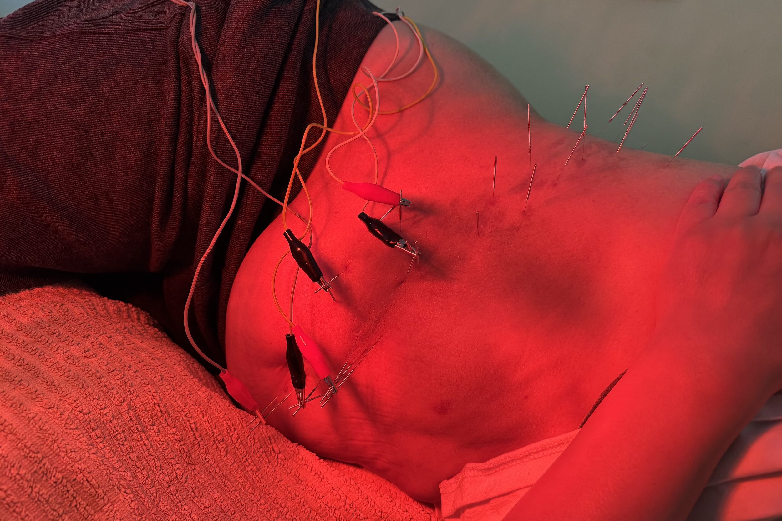 Post-Herpetic Neuralgia (PHN) 2 Electroacupuncture for postherpetic neuralgia at Almond Wellness Centre