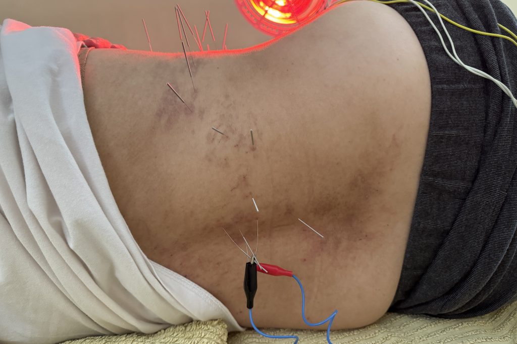 Shingles & Nerve Pain 1 electroacupuncture for shingles nerve pain at Acupuncture Melbourne Almond Wellness Centre