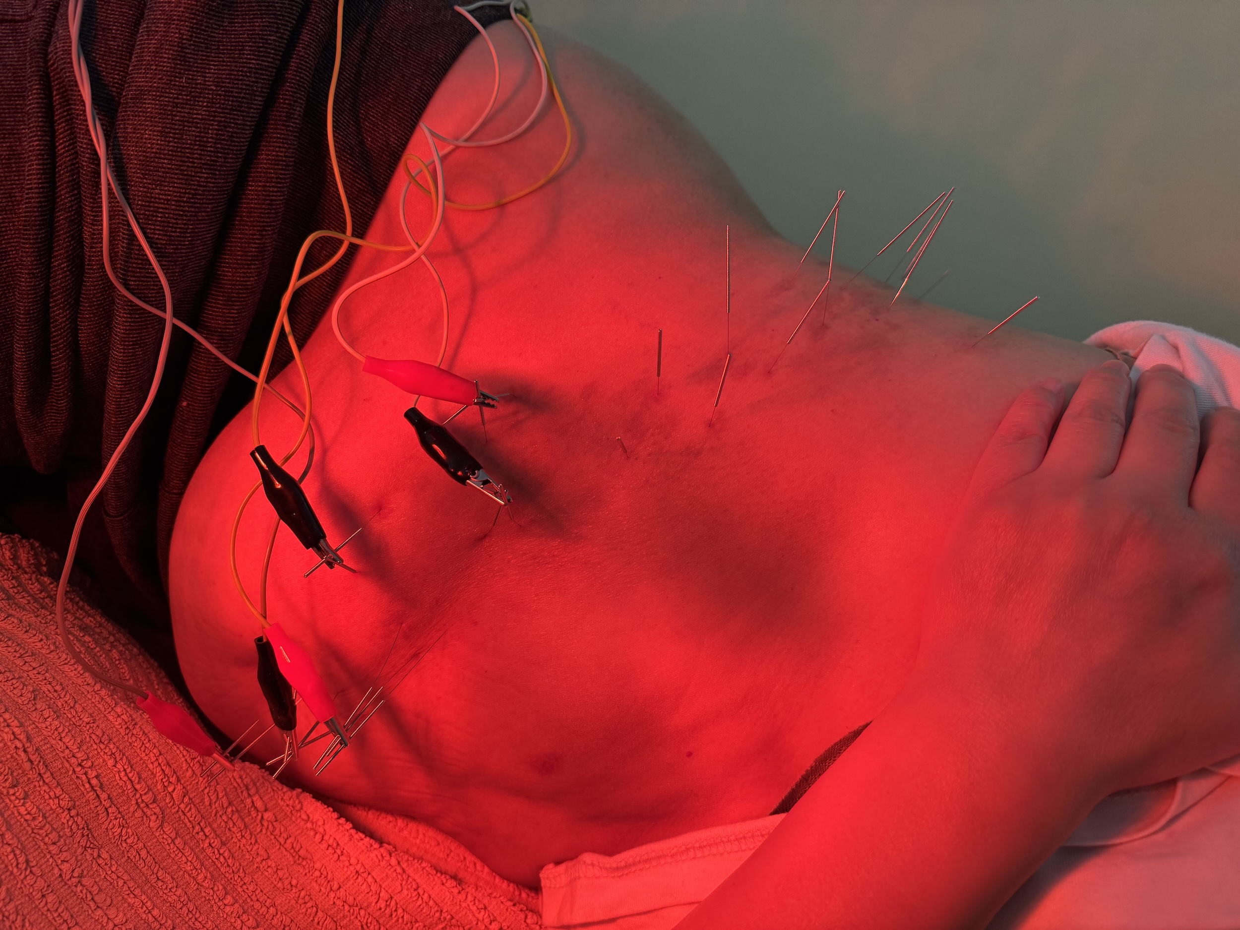 Post-Herpetic Neuralgia (PHN) 1 electroacupuncture for postherpetic neuralgia at Almond Wellness Centre Melbourne acupuncture clinic