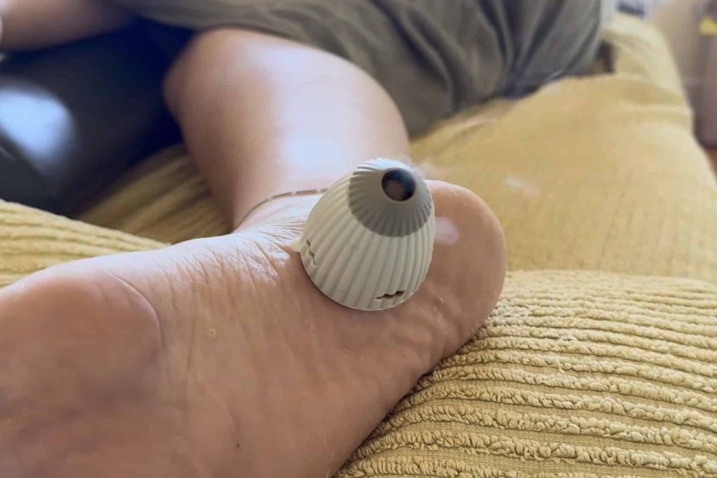 Acupuncture for Plantar Fasciitis 2 moxibustion treatment for plantar fasciitis heel pain in Melbourne